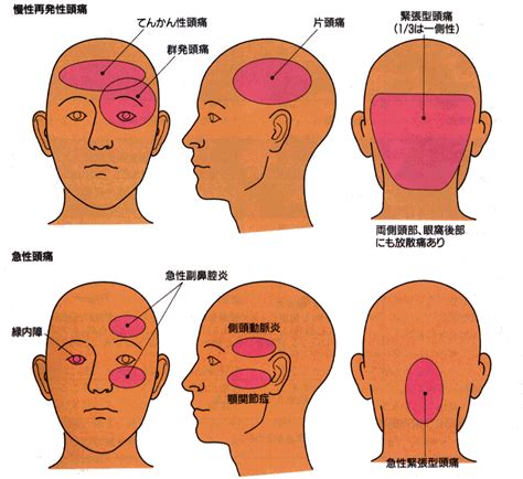 頭痛 位置|【医師監修】頭痛の場所が右か左かで原因は変わる？。